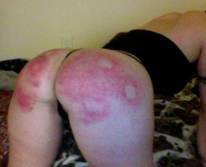 The circles in the center of the bruised areas was made with a flat wooden paddle... Happy Birthday to me!