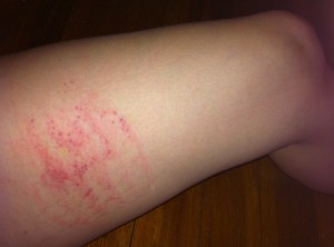 My thigh the day after Violet Wand Torture :)