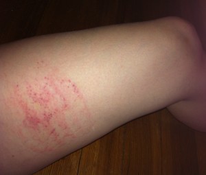 The morning after Violet Wand torture thigh marks